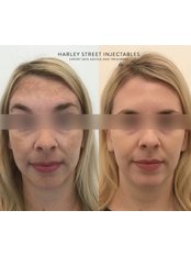 Pigmentation Treatment - Harley Street Injectables