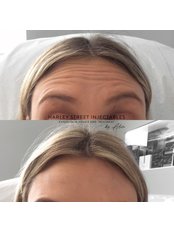 1 Area - Harley Street Injectables