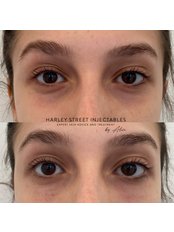 Tear trough - Harley Street Injectables
