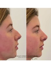 Non-Surgical Nose Job - Harley Street Injectables