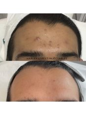 Acne Treatment - Harley Street Injectables