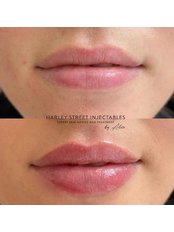 Lip Augmentation - Harley Street Injectables