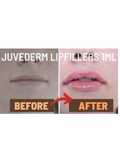 Lip Augmentation 1ml - London Lip Clinic
