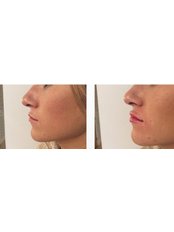 Lip Augmentation - Percam Clinic