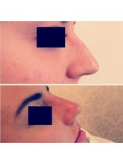 Non-Surgical Nose Job - Percam Clinic