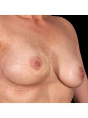 Breast Reduction - Refresh Cosmetic Surgery