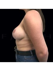 Breast Lift - Refresh Cosmetic Surgery