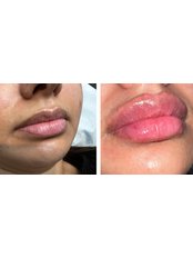 Lip Augmentation - The London Aesthetics Company