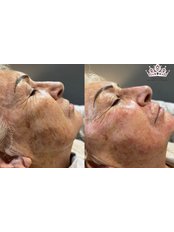Non-Surgical Facelift - The London Aesthetics Company