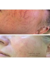 Facial Thread Veins Treatment - Aspire Beauty and Aesthetics