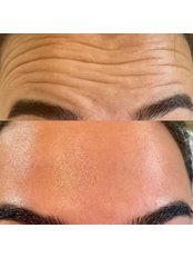 Anti Wrinkle Injections- 1 Area - Aspire Beauty and Aesthetics