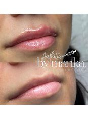 Lip Augmentation - Aspire Beauty and Aesthetics
