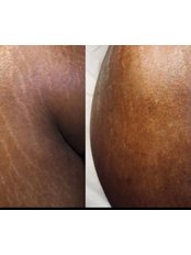 Stretch Marks Removal - Aspire Beauty and Aesthetics