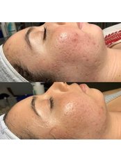 Acne Treatment - Aspire Beauty and Aesthetics