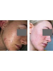 Acne Treatment - Faciem Dermatology
