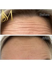 Treatment for Wrinkles - Min Aesthetics