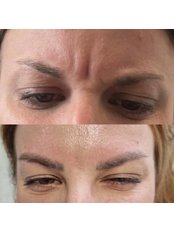 Treatment for Wrinkles - Dr Reena's Facial Aesthetics