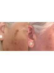 Mesotherapy - Pretty Fit Aesthetics