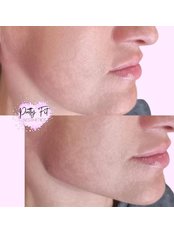 Jaw Filler - Pretty Fit Aesthetics