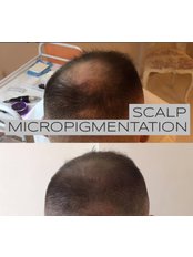 Scalp Micropigmentation - Knightsbridge Advanced Beauty
