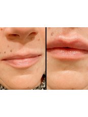 Lip Augmentation - Knightsbridge Advanced Beauty