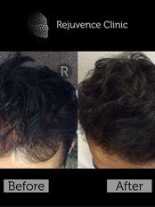 Treatment for Male Pattern Baldness - Rejuvence Clinic