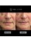 Rejuvence Clinic - Before and After - Nasolabial Folds 