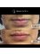 Rejuvence Clinic - Before and After - Lip Fillers 
