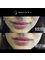 Rejuvence Clinic - Before and After - Luscious Lips 