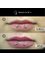 Rejuvence Clinic - Before and After - Lips with piercings 