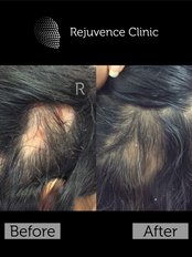 Alopecia Areata - Treatment - Rejuvence Clinic
