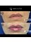 Rejuvence Clinic - Before and After - Fuller Lips 