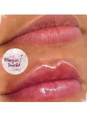 Lip Filler - The Magic Touch Clinic