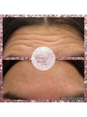 Treatment for Wrinkles - The Magic Touch Clinic