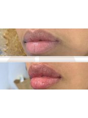 Lip Augmentation - FA Aesthetics