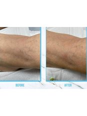 Sclerotherapy - Skin Life