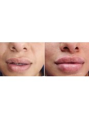 Lip Augmentation - AM Aesthetics