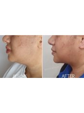 Fat Reduction Injections - AM Aesthetics