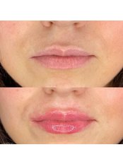 Lip Augmentation 1ml - Surgicare Aesthetics Barnet