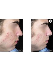 IPL Skin Rejuvenation - Beauty and skincare clinic