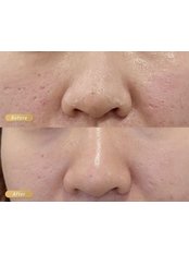 RF Microneedling- Full Face and Neck (1 Session) - Beauty and skincare clinic