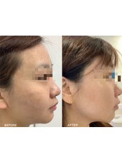 Microneedling- 1 Session - Beauty and skincare clinic
