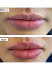Lip Augmentation- JUVEDERM - Beauty and skincare clinic