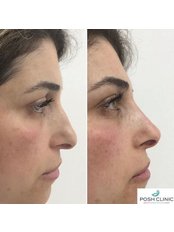 Non-Surgical Nose Job - POSH Beauty Aesthetics and Laser Clinic
