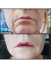 Lips - Hollywood-derma Aesthetics