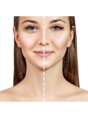 Tear Trough Jalupro Skin Boosters - Natural Enhancement Clinic