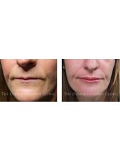 Lip Blush Permanent Makeup - The Dermatography Clinic