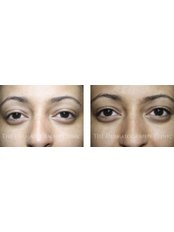 Eyeliner Permanent Makeup - The Dermatography Clinic