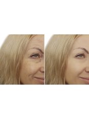 Treatment for Wrinkles - Radiant Aesthetics