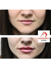 Lip Augmentation - Aesthetics by Silvie